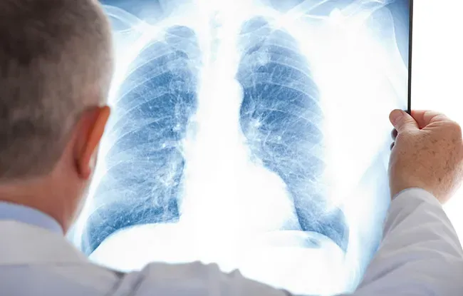 Cancer du poumon : l’Institut Curie engagé pour le dépistage organisé à travers une étude francilienne originale