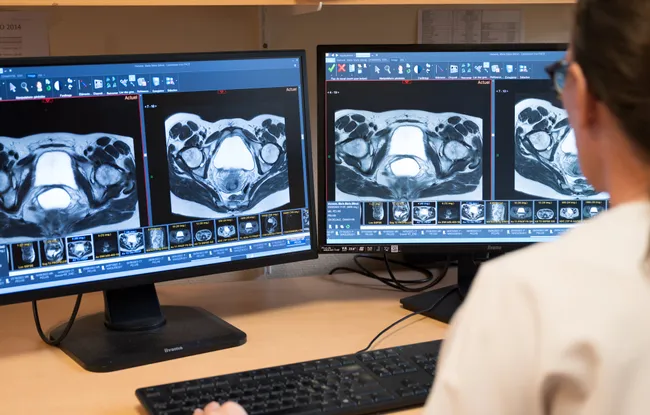 Cancer du col de l’utérus
