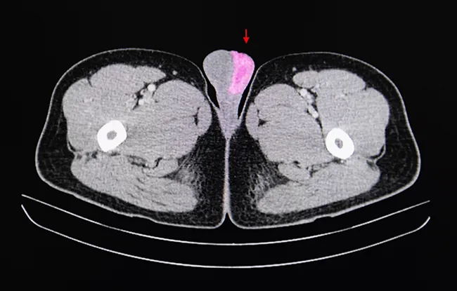 Cancer des testicules